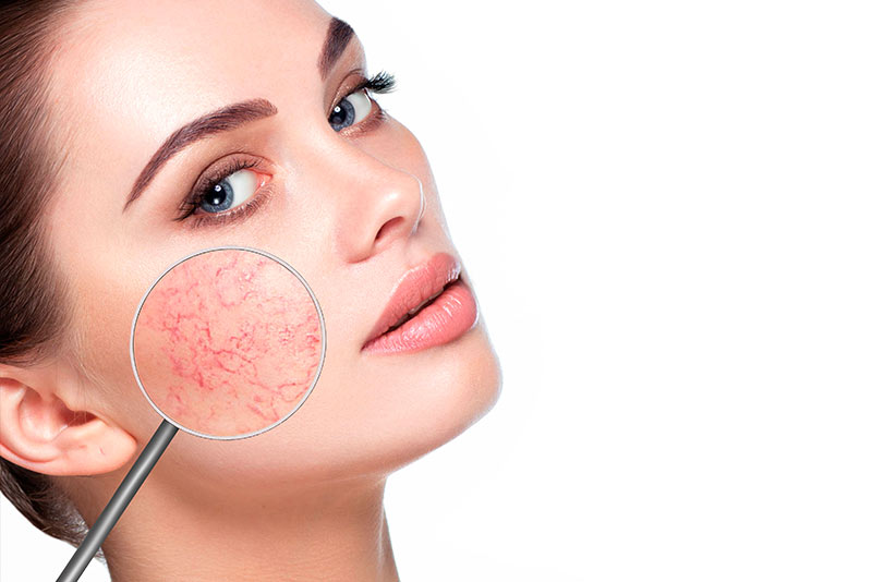 piel sensible tratamientos y cosmetica